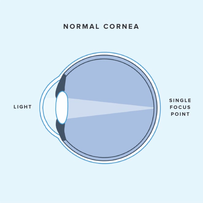 Diagram of light refracting in a normal eye
