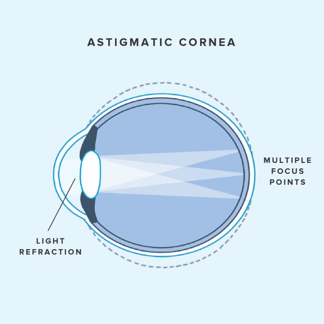 Diagram of light refracting in an eye with astigmatism