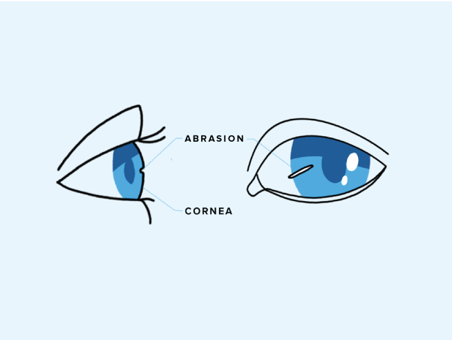 Diagram of a corneal abrasion seen from the side and front