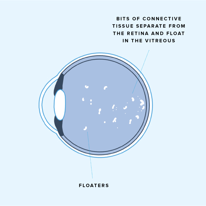 Diagram of eye floaters inside an eye