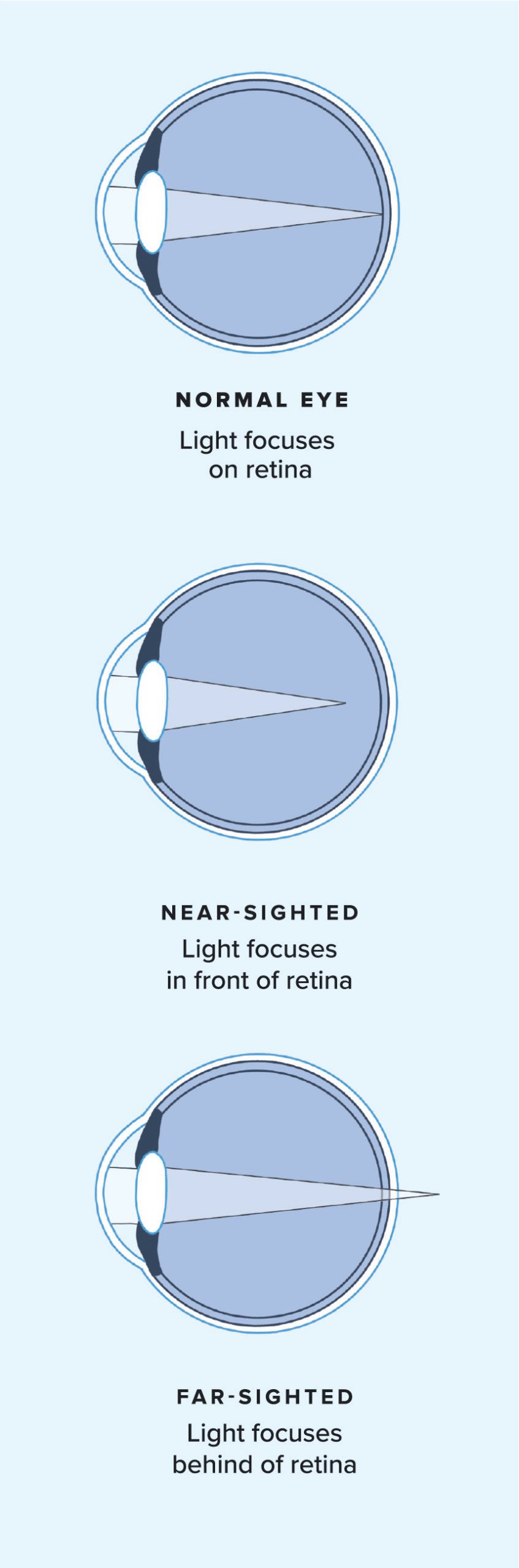 Diagram of how light focuses in a normal eye, a nearsighted eye, and a farsighted eye