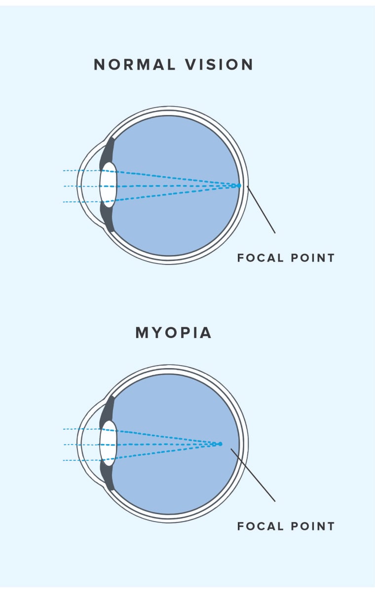 Diagram showing how light focuses in a normal eye and an eye with myopia