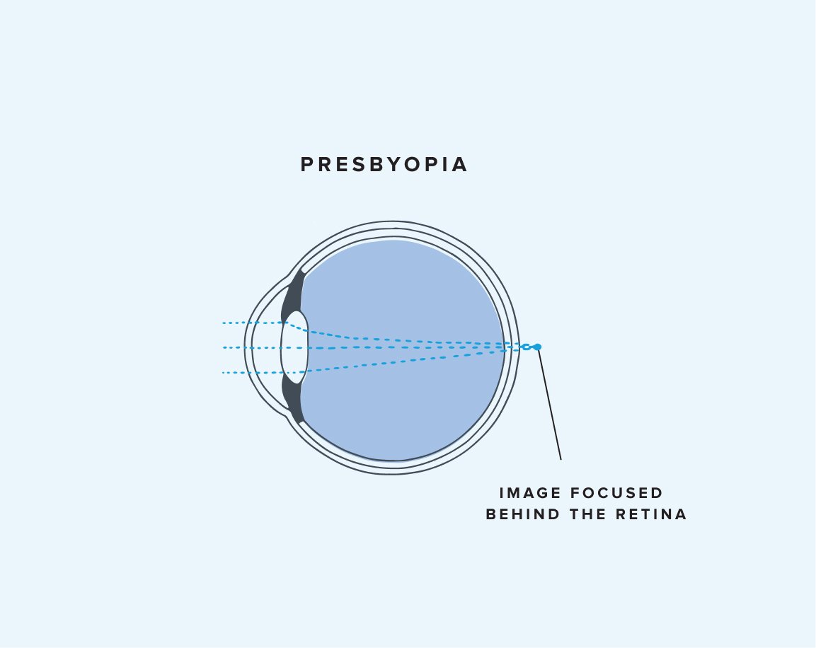 diagram of a presbyopic eye