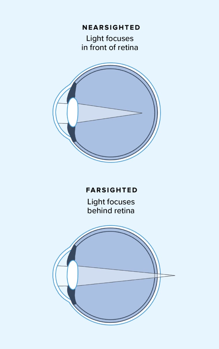Diagram comparing nearsighted and farsighted eyeballs