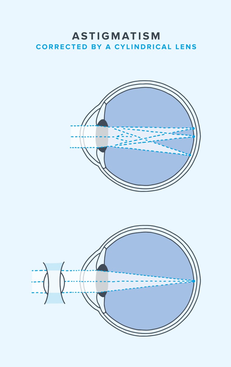Diagram of astigmatism being corrected by a cylindrical lens