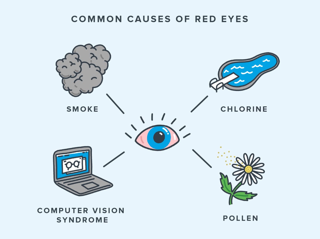 Infographic providing details on common causes of red eye including smoke, a pool with chlorine, a laptop, and a flower for pollen allergy