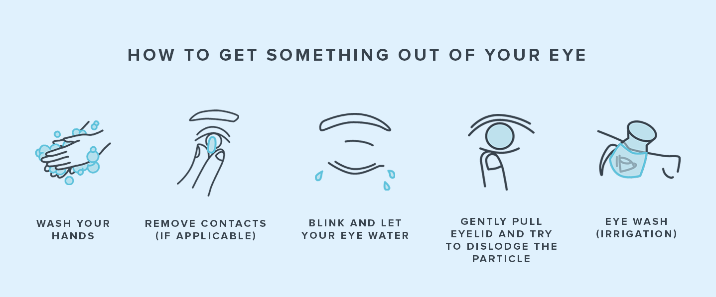 An animated gif showing the five recommended steps for getting something out of your eye.