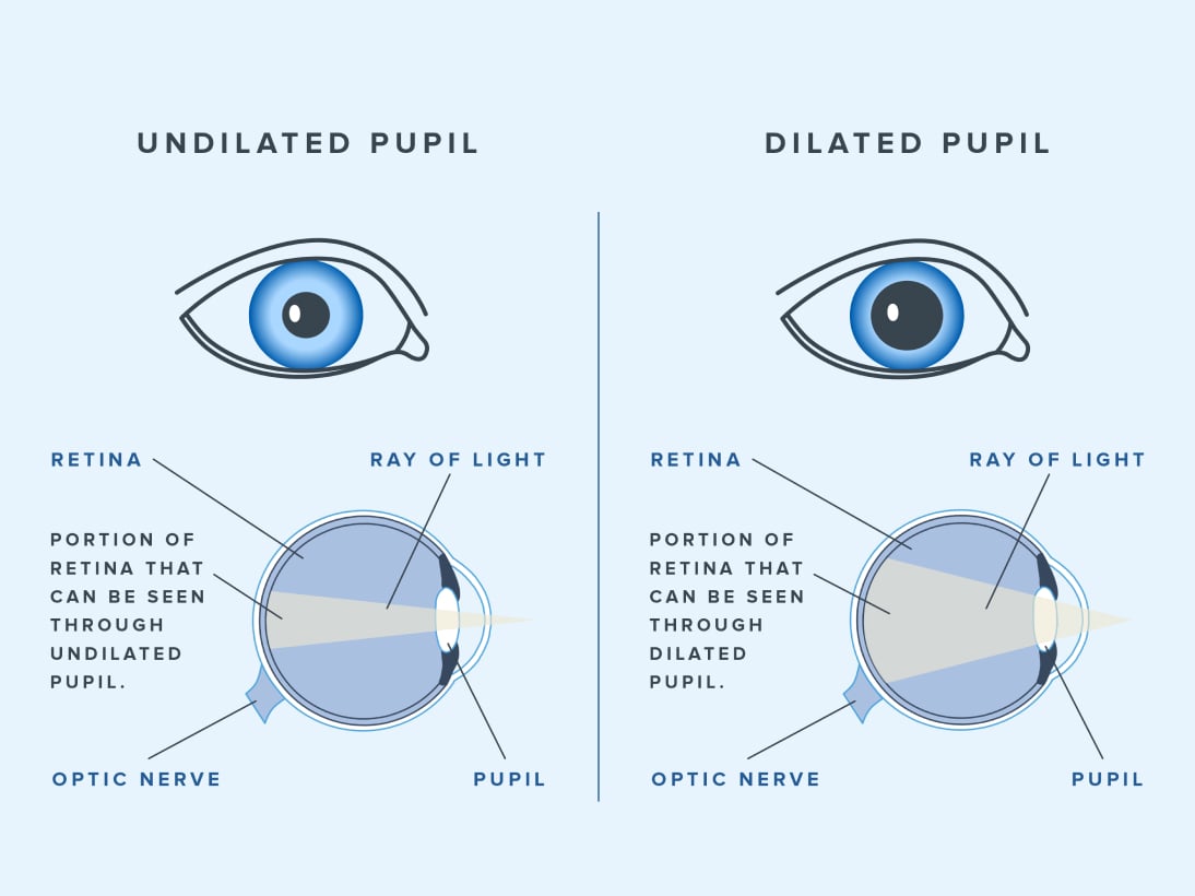 Inforgraphic comparing dilated vs. undilated pupils
