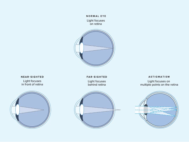 Illustrations comparing normal, nearsighted, farsighted, and astigmatic vision