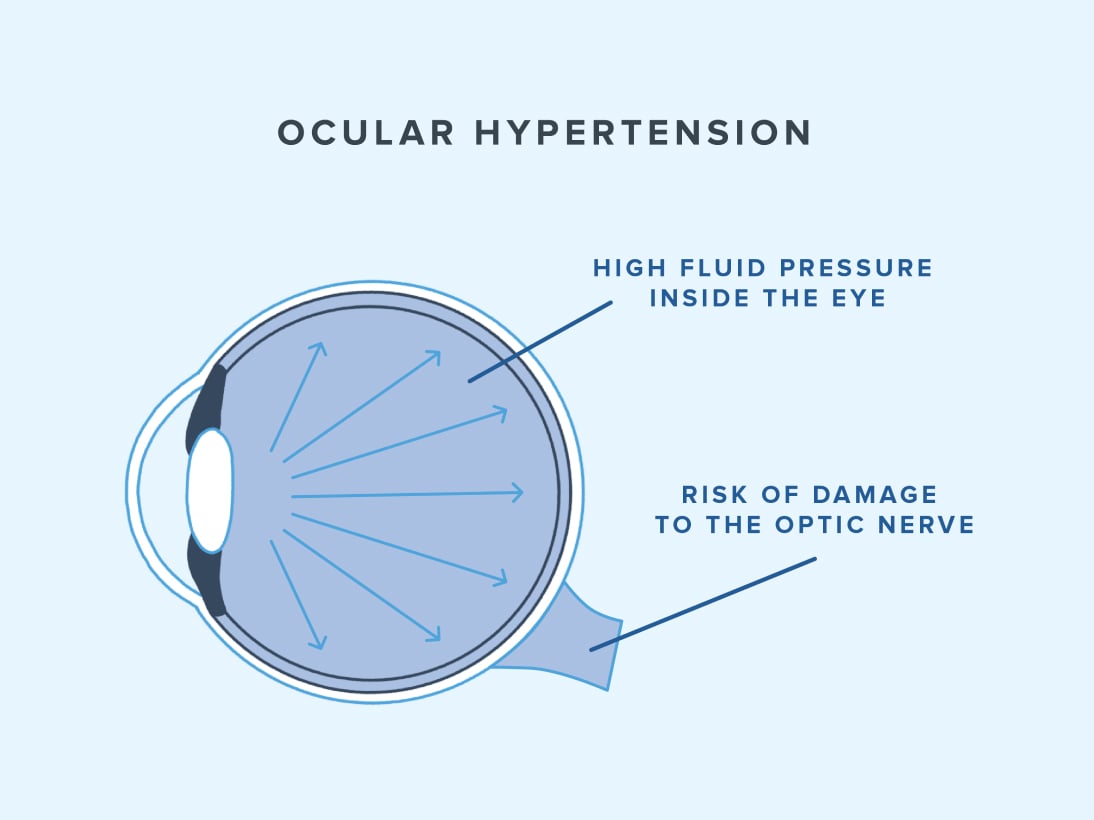 Diagram of ocular hypertension