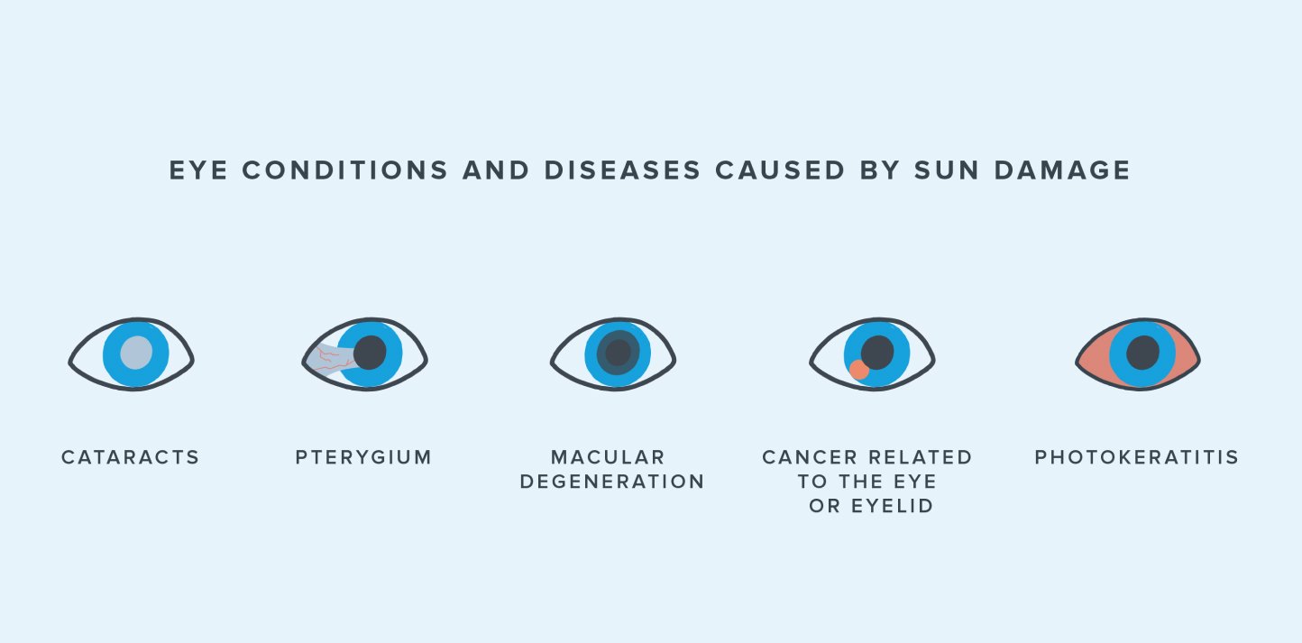 Diagram of types of damage to eyes from sunlight