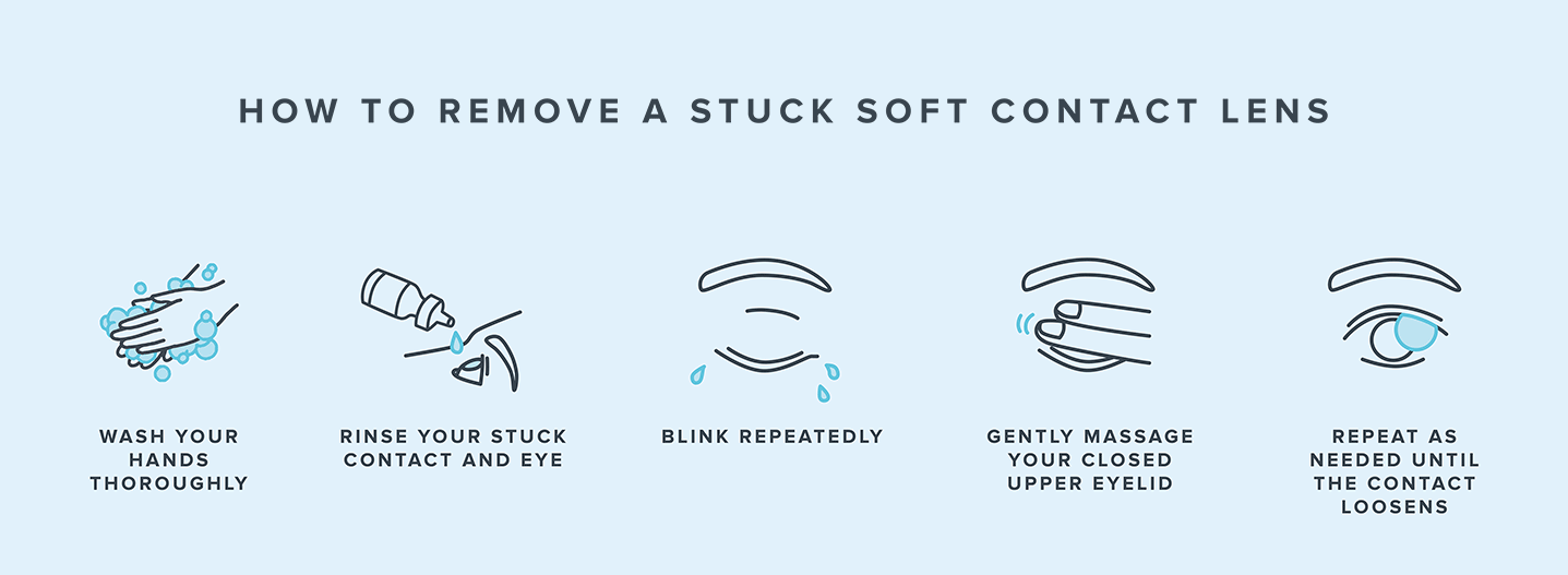Infographic illustrating the steps to remove a stuck soft contact lens