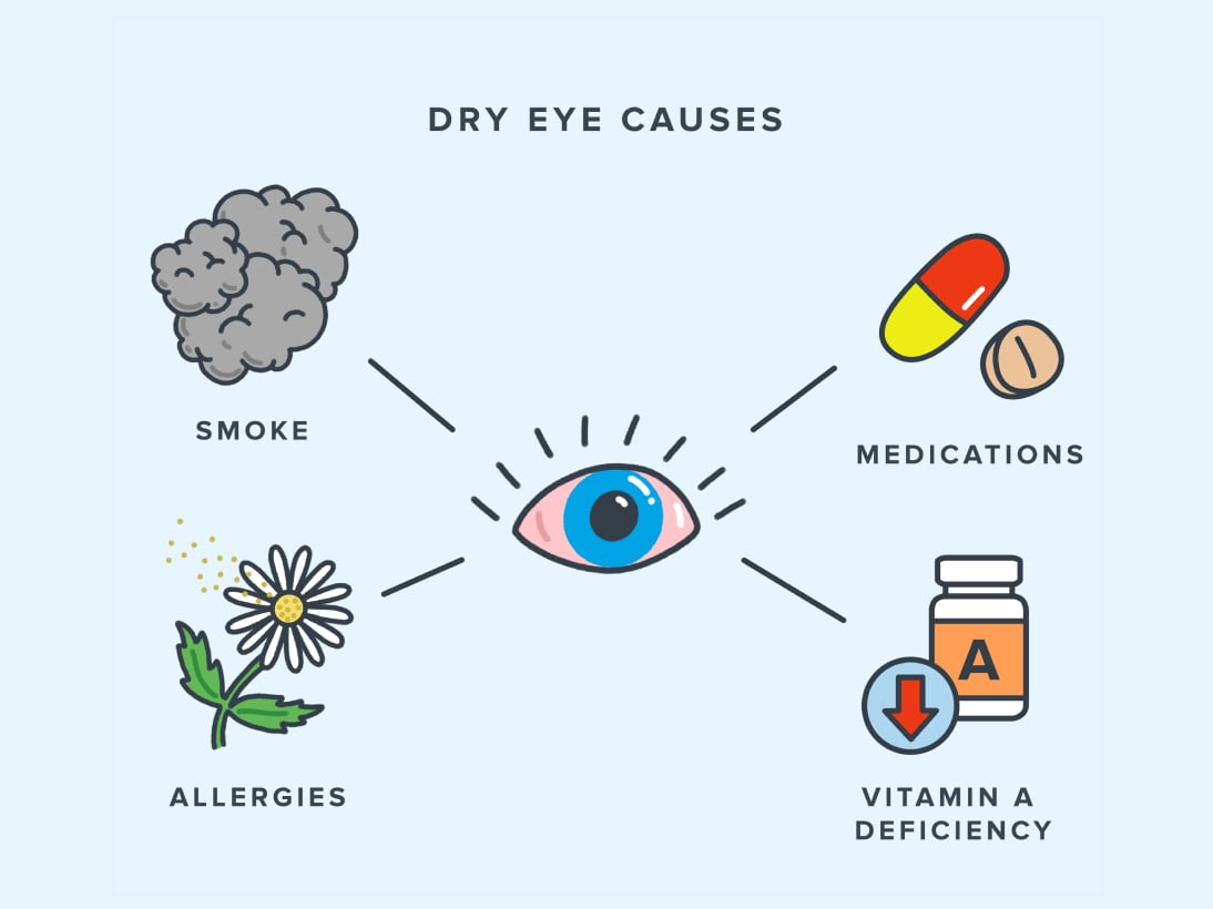 Infographic showing common causes of dry eyes