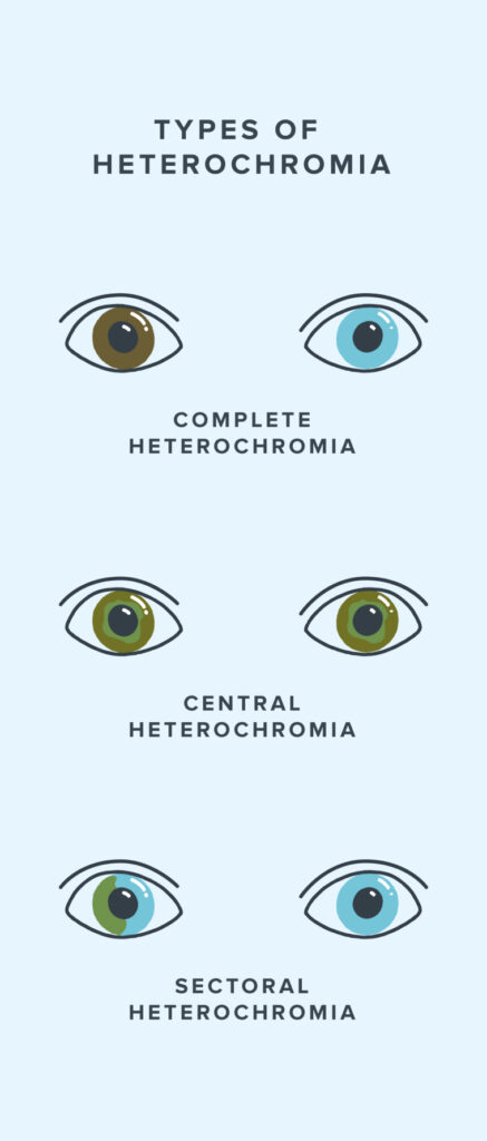 What Is Heterochromia of the Eyes? | Warby Parker