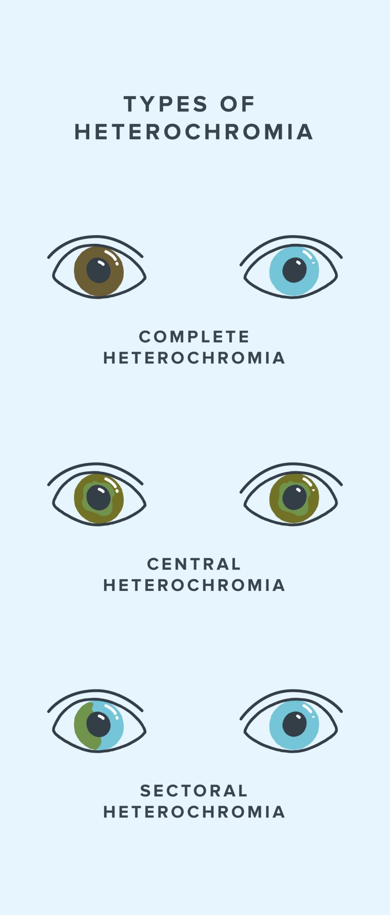 Infographic showing the different types of heterochromia