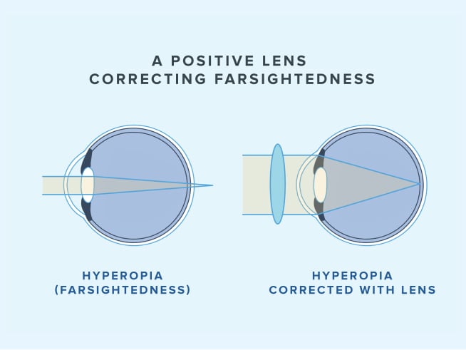infographic of lens with hyperopia