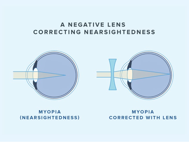 Infographic of a negative lens correcting the focal point of a myopic eye