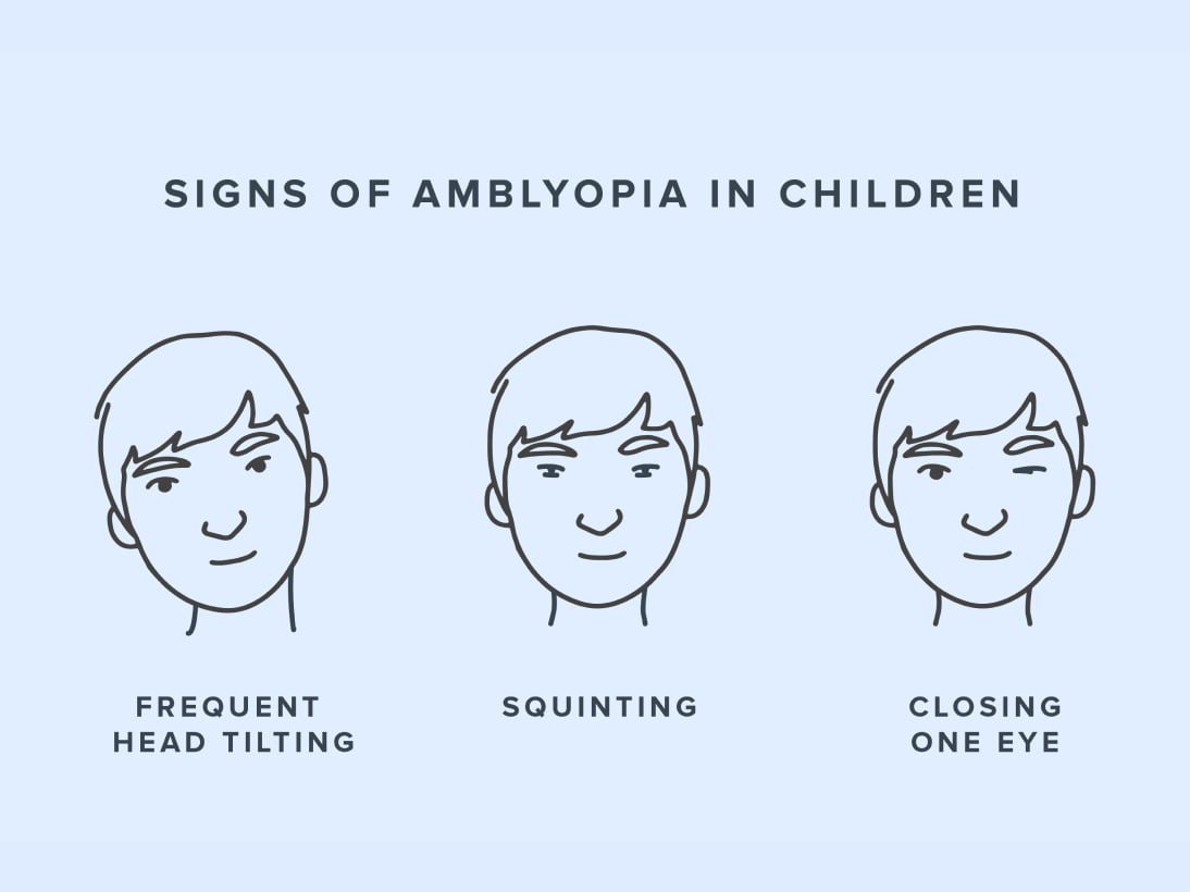 Infographic showing signs of amblyopia in children