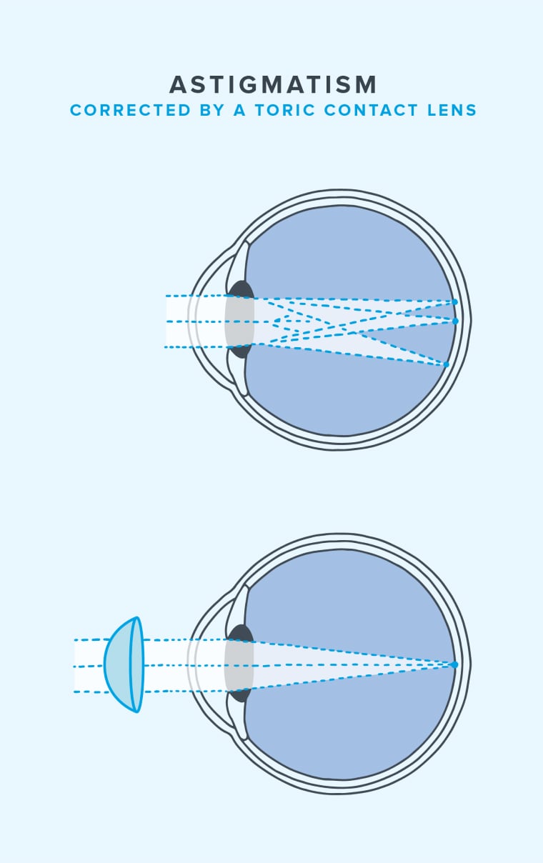 What Is The Difference Between Toric And Astigmatism Lenses?