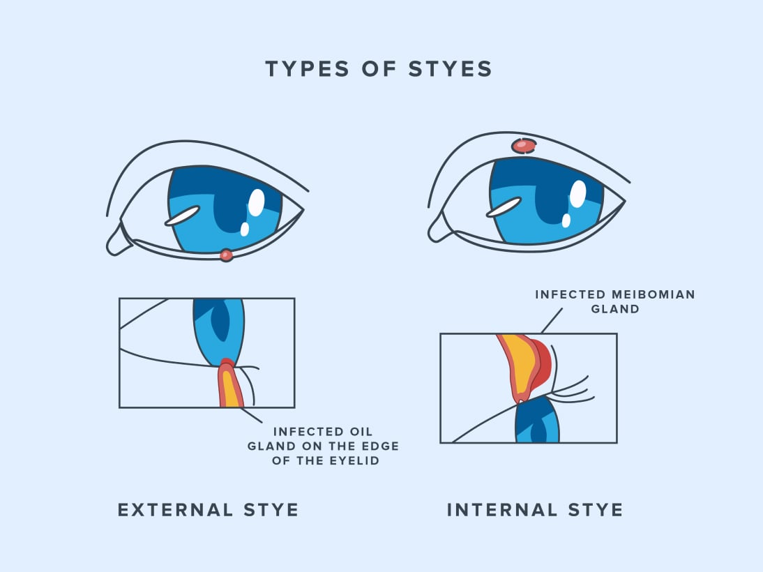 Illustration of different types of styes
