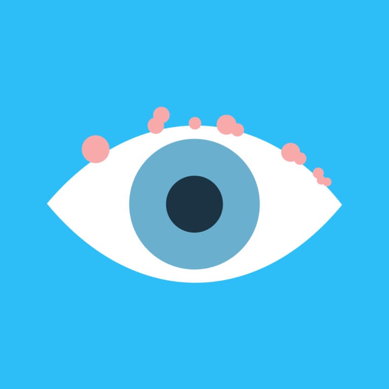 Blepharitis Symptoms, Causes, and Treatment Warby Parker