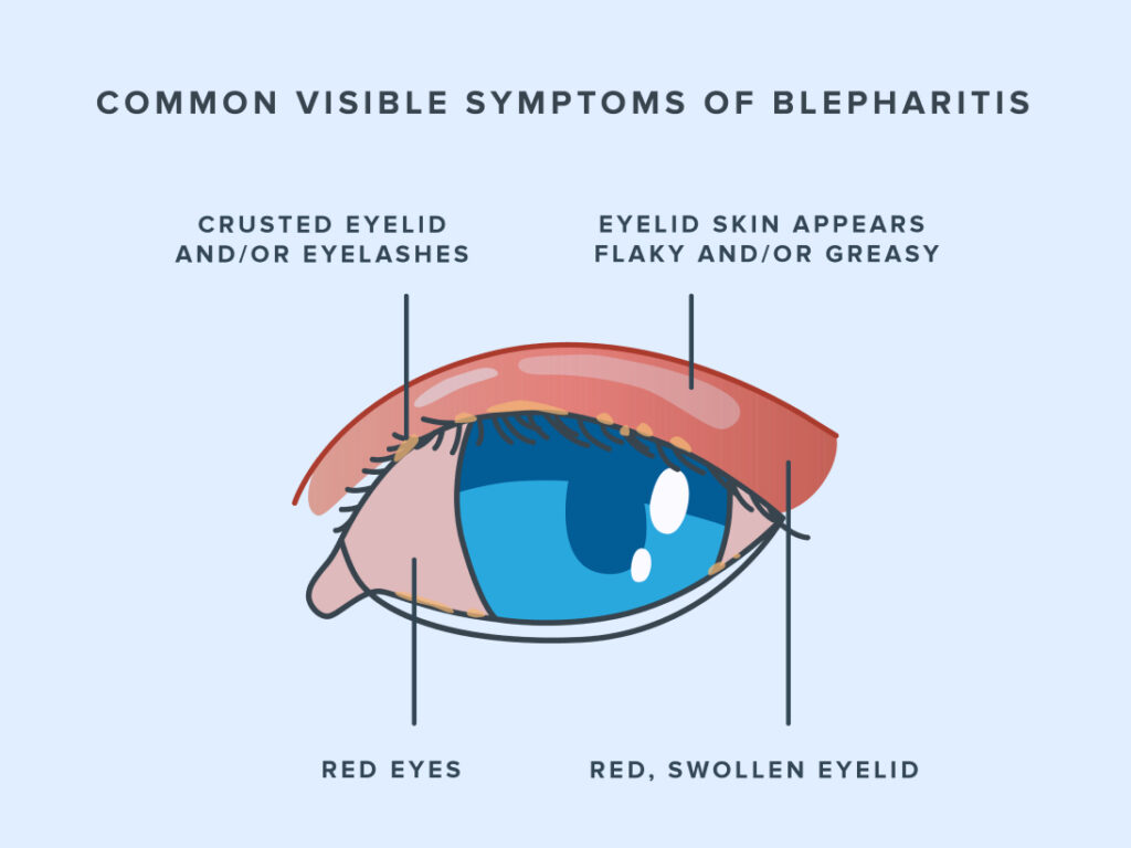 Blepharitis Symptoms, Causes, and Treatment Warby Parker