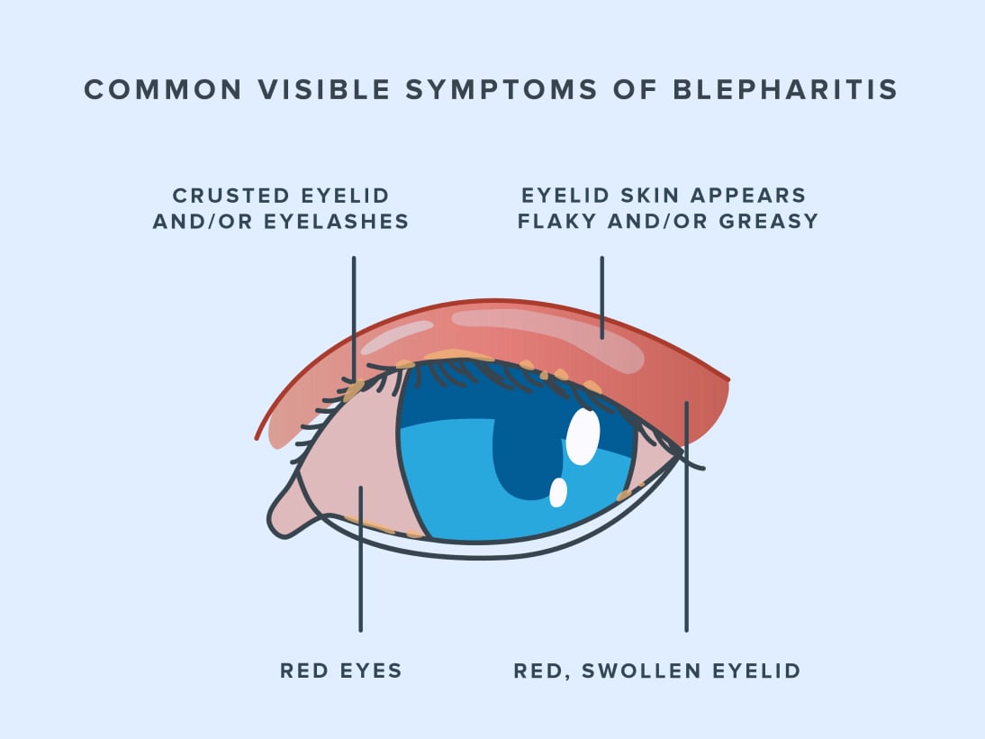 Diagram illustrating symptoms of blepharitis