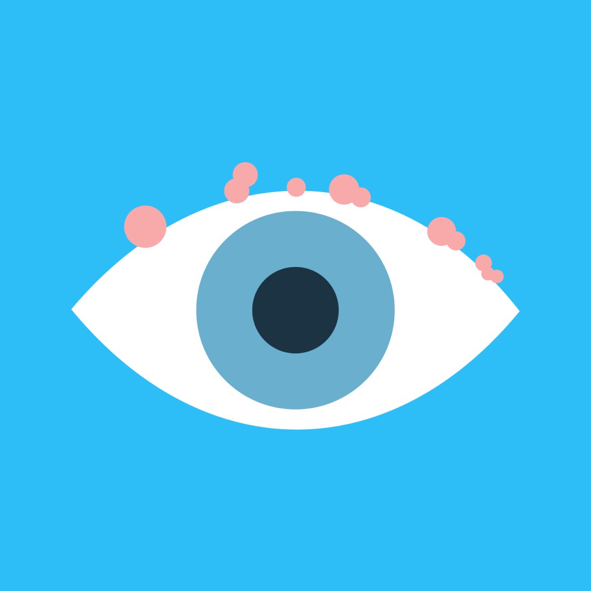 Illustration of an eye with blepharitis