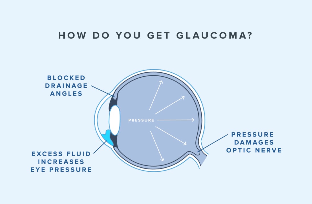 infographic of how you can get glaucoma