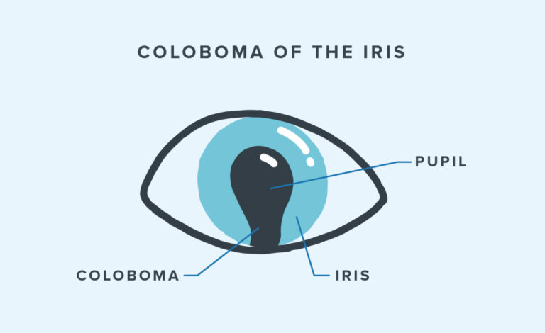 Rare Eye Diseases | Warby Parker
